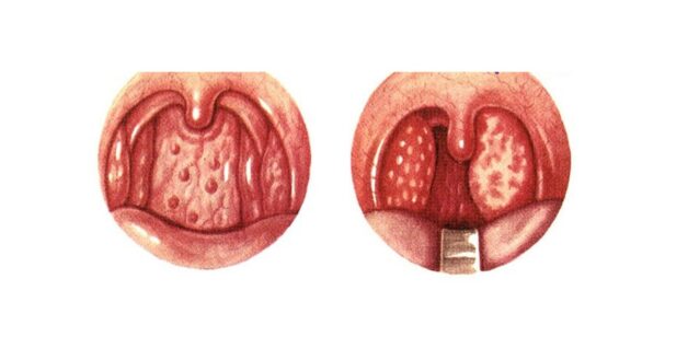 Nhận biết sớm và chính xác các biểu hiện viêm họng hạt