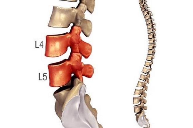 Nhận biết thoát vị đĩa đệm L4 L5 và cách điều trị