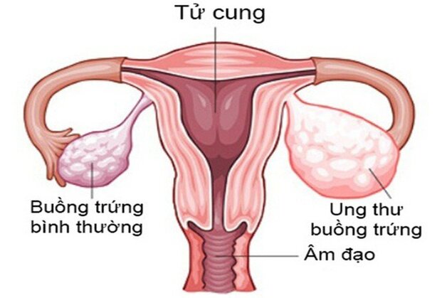 Nhận biết u nang buồng trứng ác tính và cách phòng ngừa