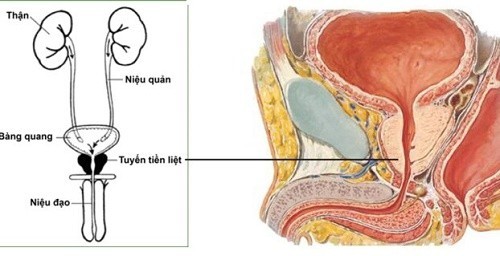 Nhận biết u xơ tuyến tiền liệt