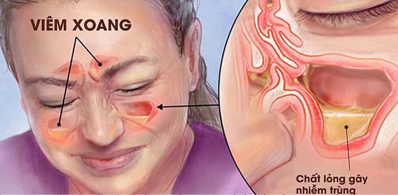 Nhận biết và thực hiện đúng cách điều trị viêm xoang mãn tính