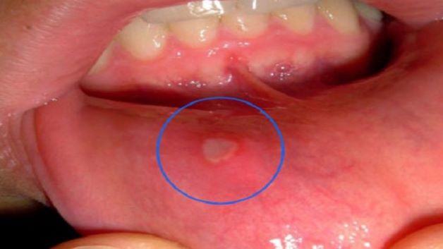 Nhận biết và xử trí viêm lợi miệng Herpes nguyên phát ở trẻ