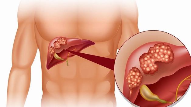 Nhận biết viêm gan nhiễm độc và cách phòng ngừa