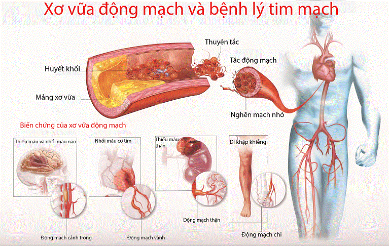 Nhận biết xơ vữa động mạch vành