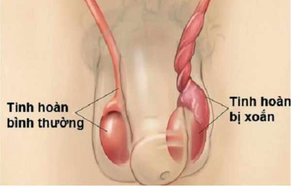 Nhận biết xoắn tinh hoàn ở trẻ em: Biểu hiện và cách điều trị