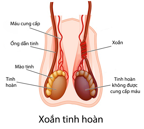 Nhận biết xoắn tinh hoàn ở trẻ em: Biểu hiện và cách điều trị