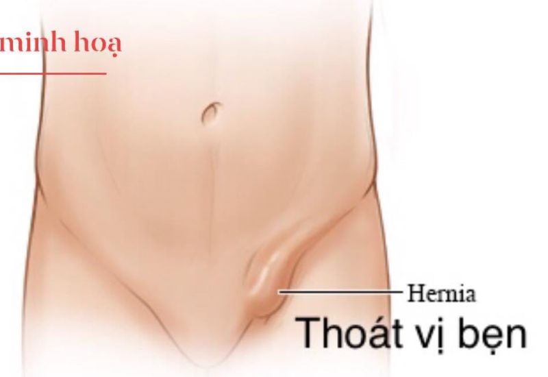 Nhận diện sớm các biểu hiện thoát vị bẹn