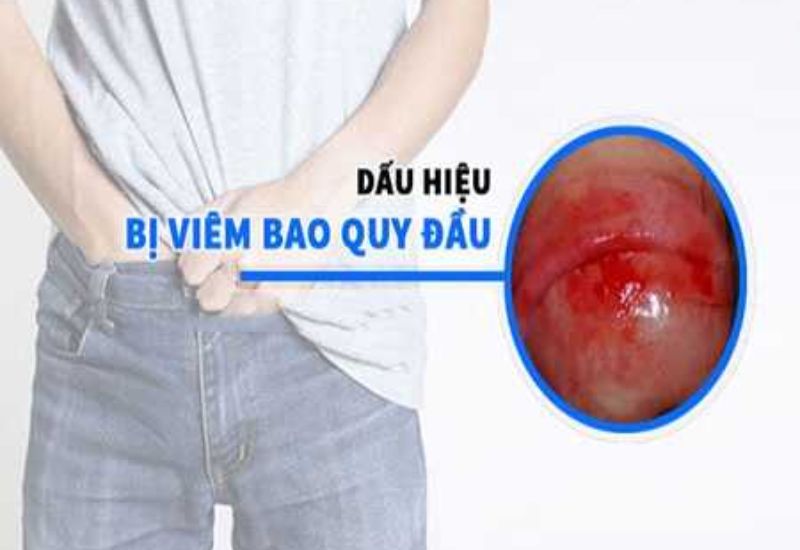 Nhận diện triệu chứng hẹp bao quy đầu để điều trị kịp thời