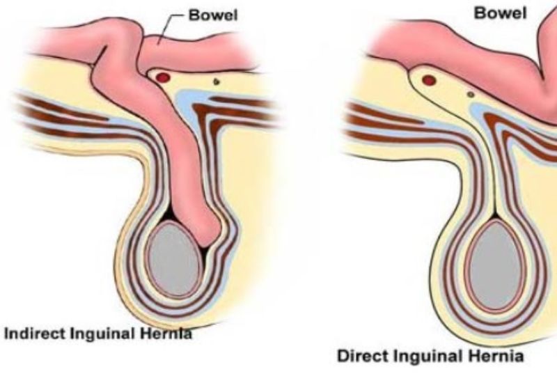 Nhận diện triệu chứng thoát vị bẹn và cách điều trị