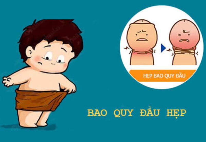 Nhận diện và xử trí hẹp bao quy đầu, giúp nam giới lấy lại tự tin