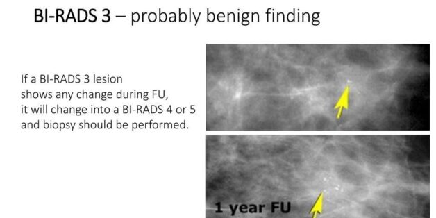 Nhân tuyến vú BIRADS 3 liệu có nguy hiểm?