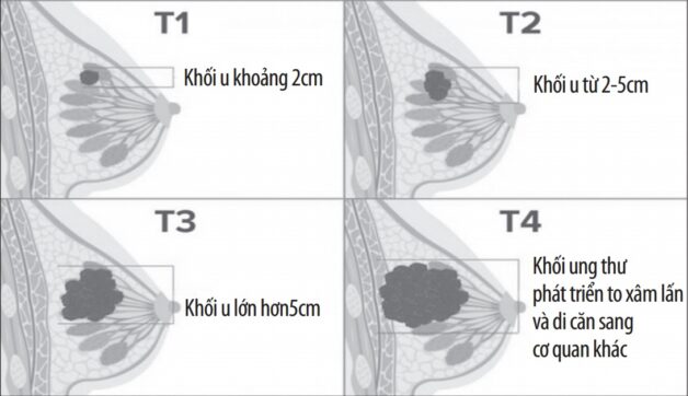 Nhân tuyến vú BIRADS 3 liệu có nguy hiểm?