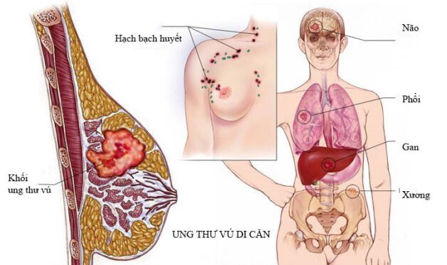 Nhân tuyến vú BIRADS 3 liệu có nguy hiểm?