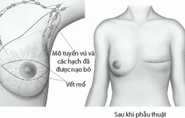 Nhân tuyến vú BIRADS 4 là gì? Cách điều trị