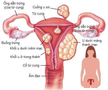 Nhân xơ tử cung 10mm điều trị cách nào?