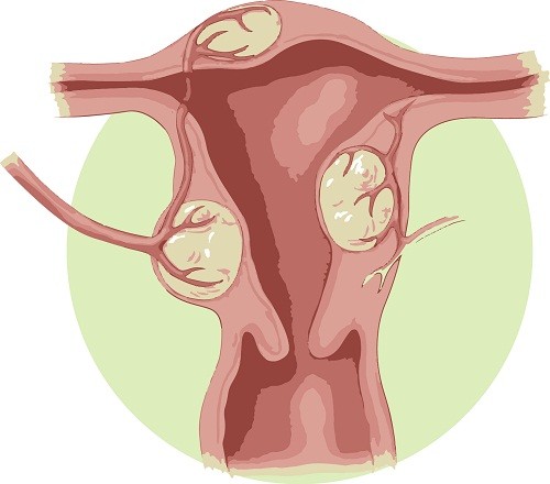 Nhân xơ tử cung là gì? khối u phát triển từ thành tử cung