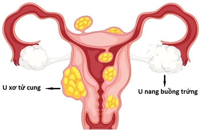 Nhân xơ tử cung nên uống thuốc gì?