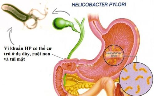 Nhiễm khuẩn HP là gì? Có gây nguy hiểm không?