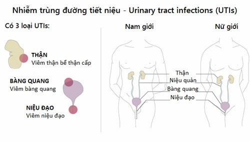 Nhiễm trùng đường tiết niệu, làm sao để phòng ngừa?