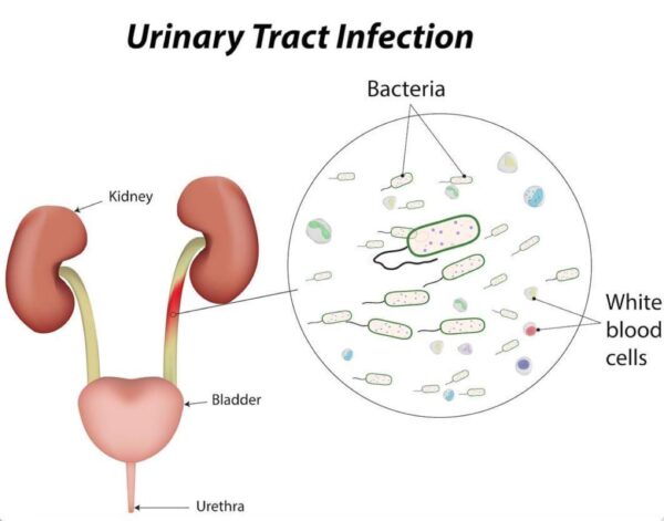 Nhiễm trùng đường tiểu ở trẻ em có nguy hiểm không?