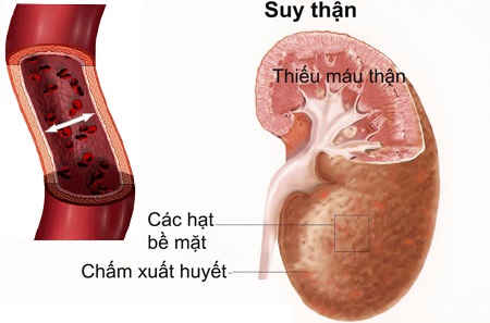 Nhiễm trùng tiểu ở trẻ em nguy cơ gây sẹo thận, suy thận