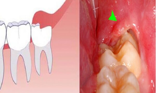 Nhiều người thắc mắc có cần thiết phải nhổ răng khôn