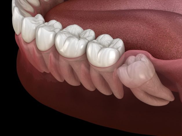 Nhổ 2 răng khôn cùng lúc có hại cho sức khoẻ không?