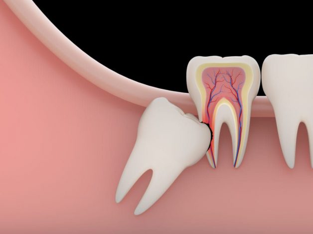 Nhổ 4 răng khôn cùng lúc được không?