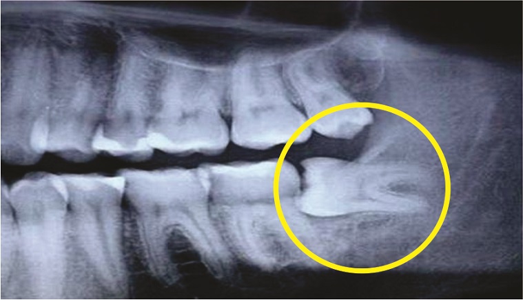 Nhổ răng khôn có đau không? Yếu tố ảnh hưởng đến nhổ răng khôn là gì?