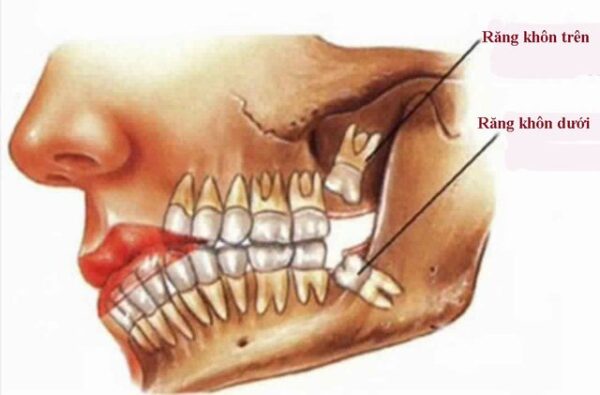 Nhổ răng khôn hàm trên và cách chăm sóc sau nhổ