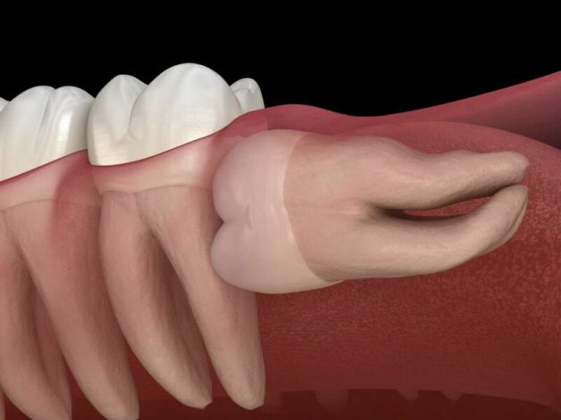 Nhổ răng khôn khi nào lành, bài viết dưới đây sẽ giải đáp thắc mắc