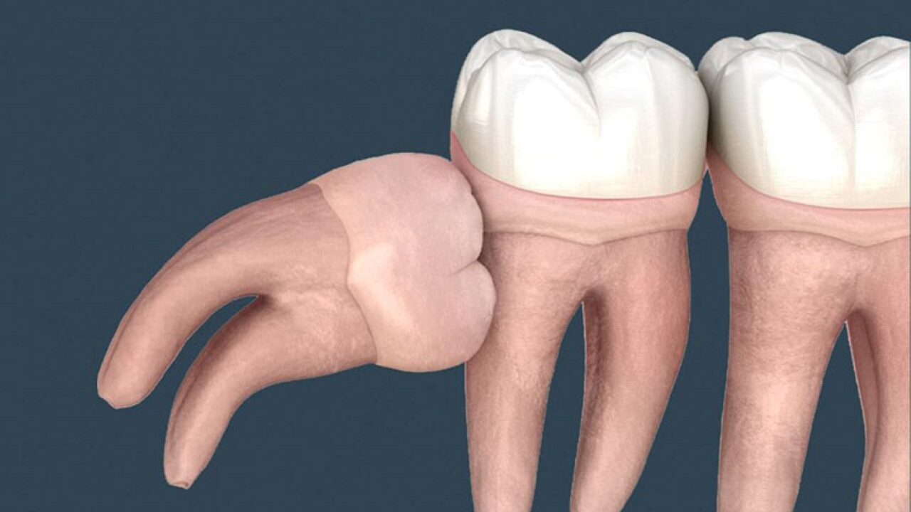 Nhổ răng khôn mọc lệch và lưu ý không thể bỏ qua