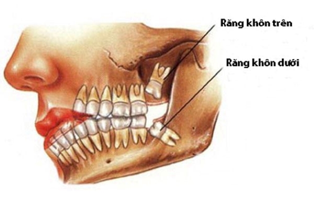 Nhổ răng khôn nguy hiểm không và lưu ý