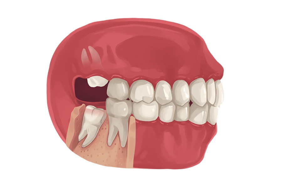 Nhổ răng khôn nguy hiểm không? Yếu tố ảnh hưởng đến nhổ răng khôn?