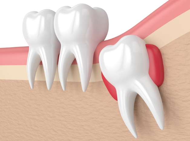 Nhổ răng khôn ở đâu đảm bảo uy tín và một số lưu ý