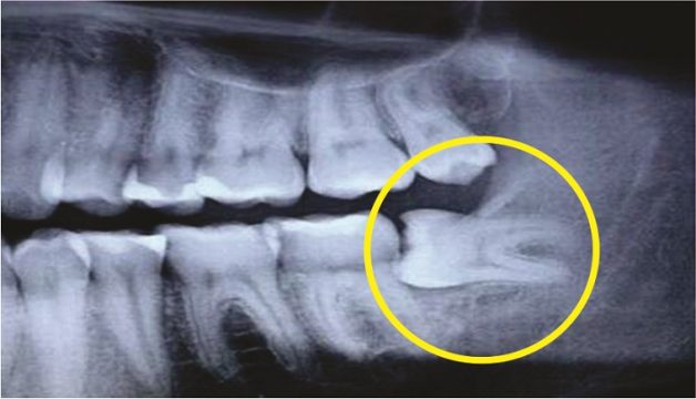 Nhổ răng khôn ở đâu uy tín và an toàn?