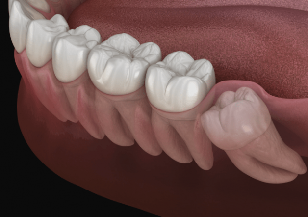 Nhổ răng khôn số 8 có nguy hiểm không, bạn có biết?