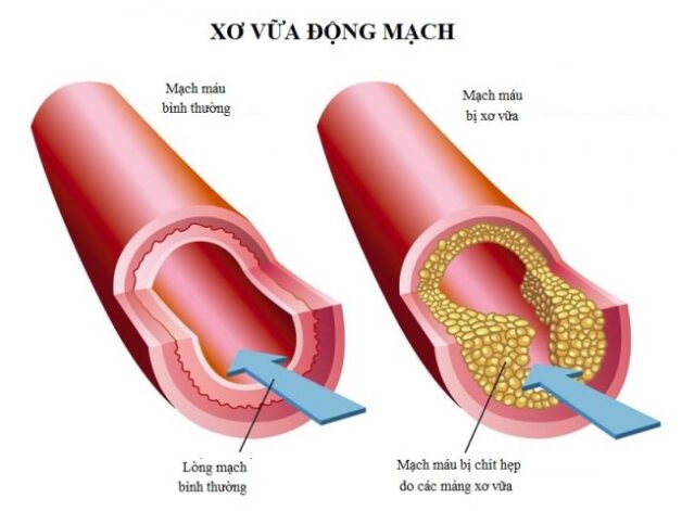 Nhồi máu cầu não: Nguyên nhân, cách điều trị