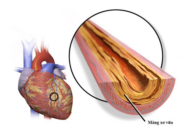 Nhồi máu cơ tim: Bệnh học biểu hiện như thế nào?