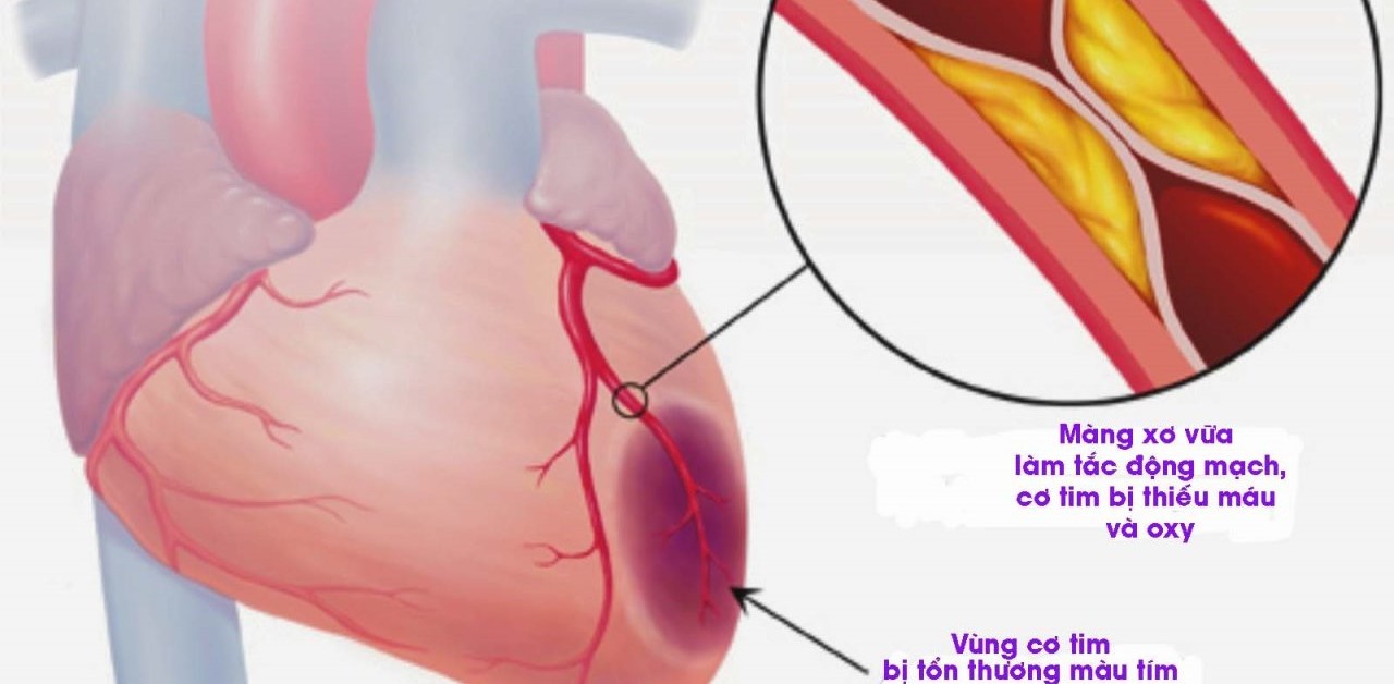 Nhồi máu cơ tim điều trị ra sao và những lưu ý sau đó