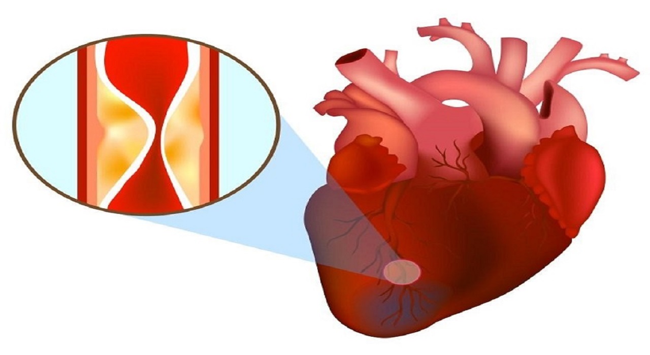 Nhồi máu cơ tim là gì và dấu hiệu nhận biết sớm