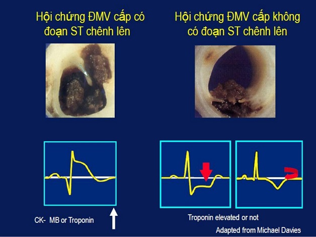 Nhồi máu cơ tim ST chênh lên là gì? Cách chẩn trị bệnh