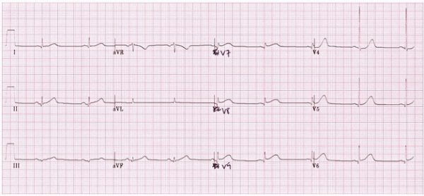 Nhồi máu cơ tim thành sau và các dấu hiệu trên điện tâm đồ