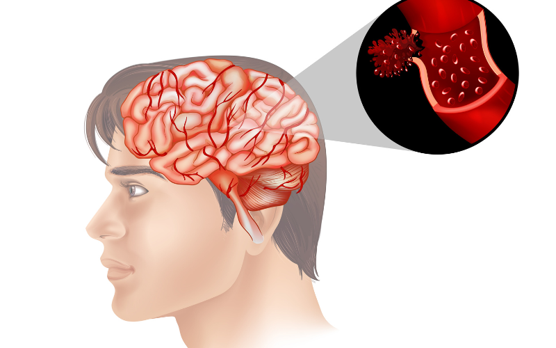 Nhồi máu não: Bộ Y tế hướng dẫn chẩn đoán và xử trí