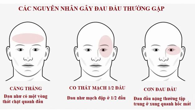 Nhức đầu mãn tính là gì? Làm thế nào để cắt cơn đau/