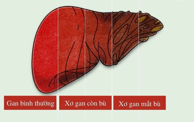 Những ảnh hưởng nghiêm trọng từ bệnh xơ gan mất bù