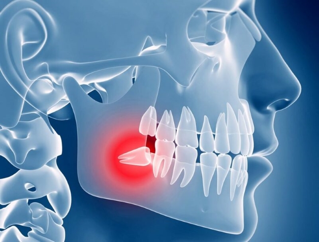 Những ảnh hưởng từ nhổ răng khôn không khâu