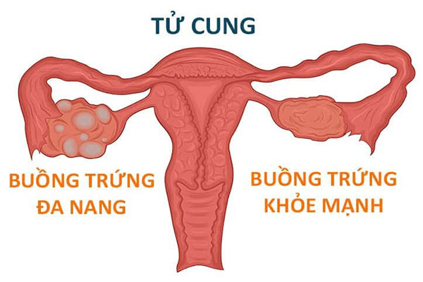 Những bệnh phụ nữ thường gặp: Nguyên nhân và cách phòng tránh