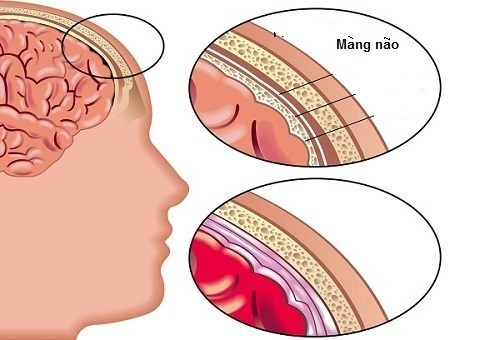 Những biến chứng nguy hiểm của bệnh viêm phổi