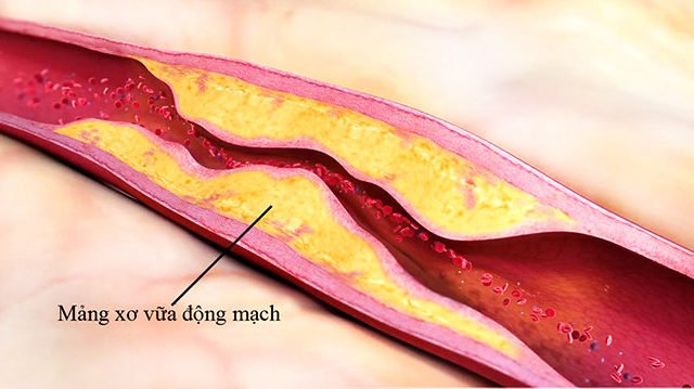 Những biến chứng sau đột quỵ có thể gặp phải